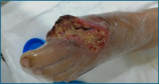 Larvas de Lucilia sericata realizando desbridamiento de tejido necrótico en un pie humano.